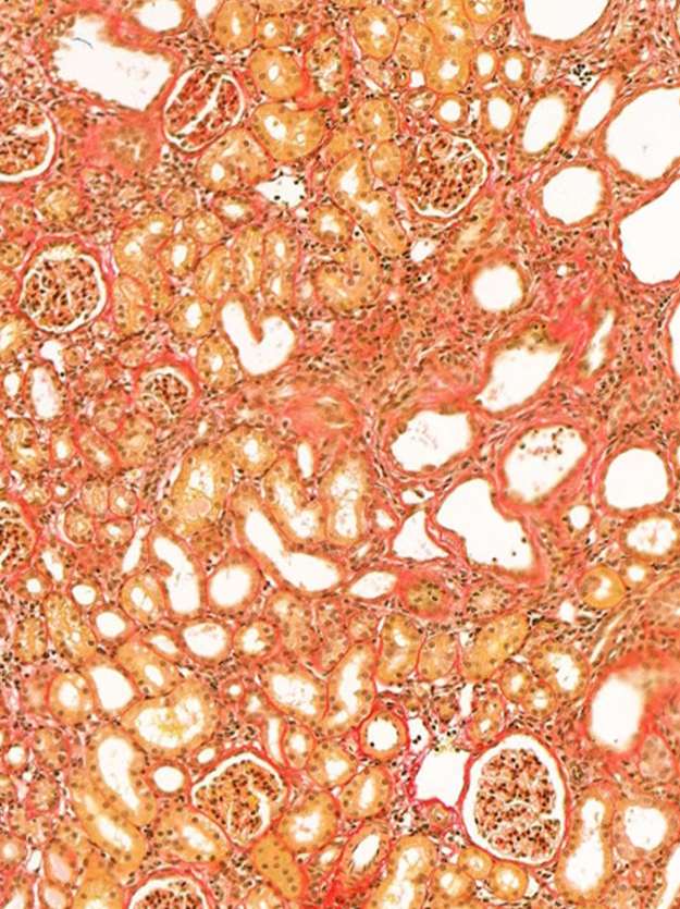 Three-Dimensional Bio-Printed Autologous Omentum Patch Ameliorates Unilateral Ureteral Obstruction Induced Renal Fibrosis